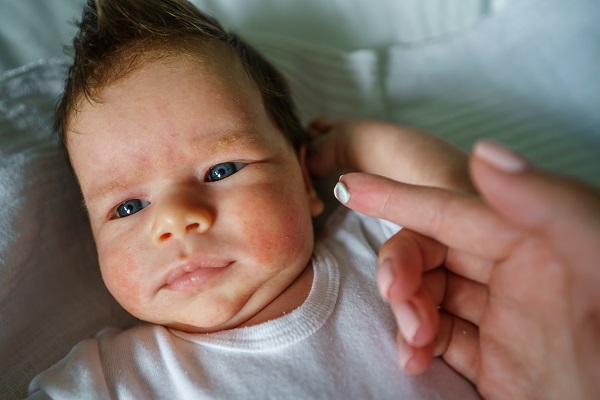 Fortbildung: Trends in der Behandlung der atopischen Dermatitis – Eliminationsdiäten: Überholt oder unverzichtbar?