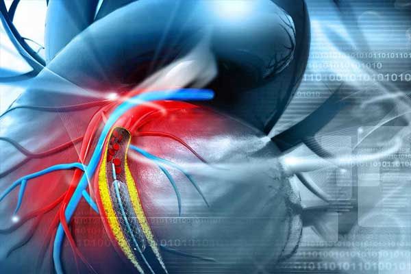 Übersicht Pulmonale Hypertonie aus pneumologischer und kardiologischer Sicht