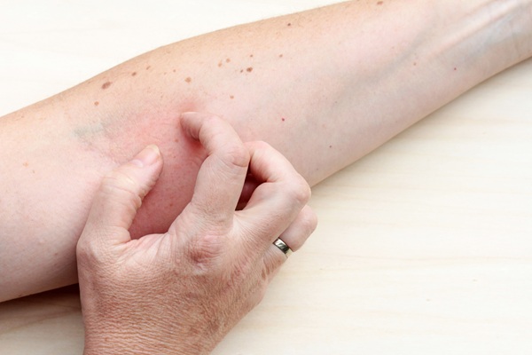 Fortbildung: Aktualisierung der evidenz- und konsensbasierten S3-Leitlinie zur atopischen Dermatitis: Systemtherapie Biologika, Schwangrschaft, Stillzeit
