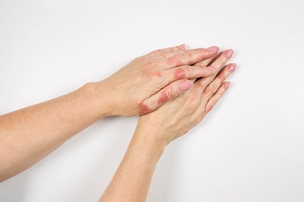 Medcram-Lernmodul | Januskinaseinhibitoren zur Therapie der atopischen Dermatitis