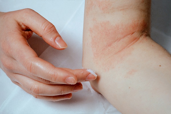 Fortbildung: S3-Leitlinie Atopische Dermatitis