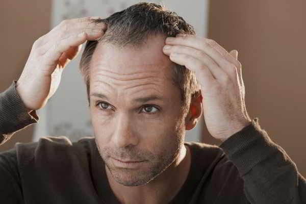 Kompetente Beratung in der Apotheke zu Haarausfall (Alopezie) – Ursachen und Therapie