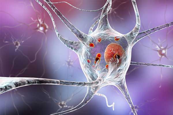 Medcram-Lernmodul | Parkinson und Bewegungsstörungen – Neues aus der Neuroimmunologie